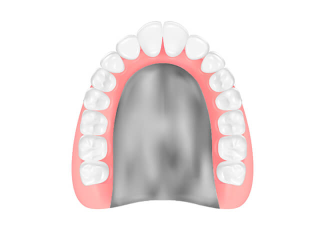 金属床義歯（チタン）