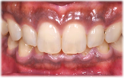 ガムピーリング